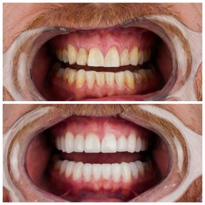Результаты до и после Hollywood Smile в Nifa Dent International – белые, ровные зубы