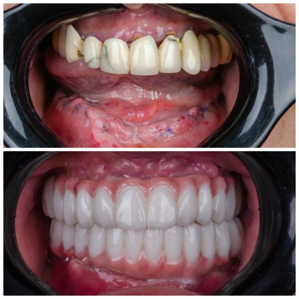 Resultados antes y después de dentaduras en Omara Dental Centers – restauración total de la sonrisa