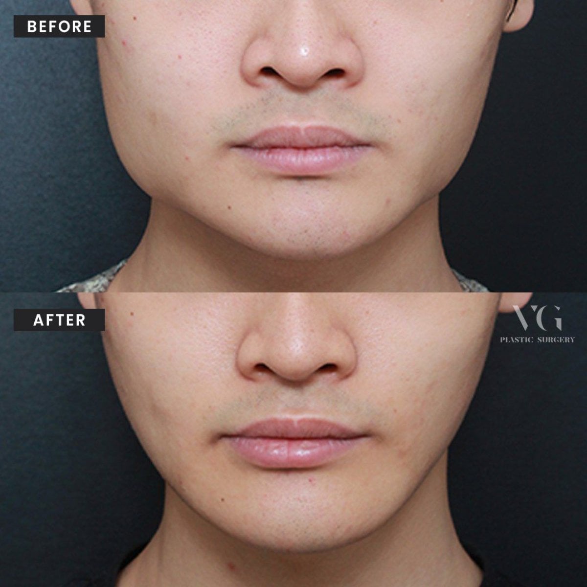 نتائج قبل وبعد تشكيل الفك في VG Plastic Surgery – تحسين تحديد الفك