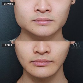 Результаты до и после коррекции челюсти в VG Plastic Surgery – улучшенный контур