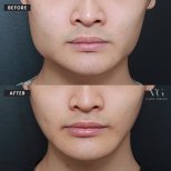 Результаты до и после коррекции челюсти в VG Plastic Surgery – улучшенный контур