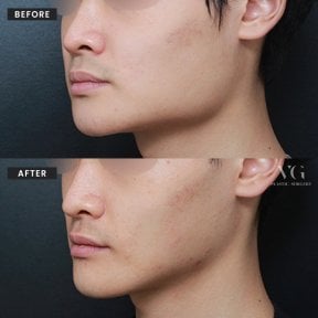 Результаты до и после коррекции челюсти в VG Plastic Surgery, улучшенный контур челюсти