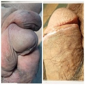Before and after penile paraffinoma surgery results at Menness Wellness Clinic, improved contour