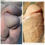 Before and after penile paraffinoma surgery results at Menness Wellness Clinic, improved contour
