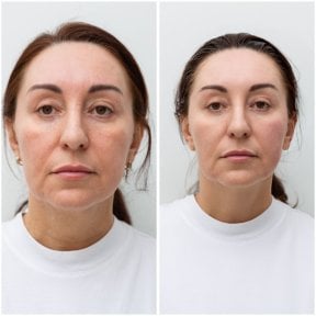 Результати до і після підтяжки обличчя в Altos Clinic, омолодження та підтяжка шкіри