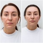 Результати до і після підтяжки обличчя в Altos Clinic, омолодження та підтяжка шкіри