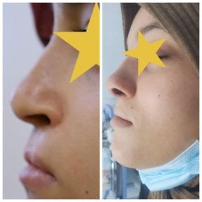 Результати до і після ревізійної ринопластики в Esthétique du Nord, покращений профіль носа