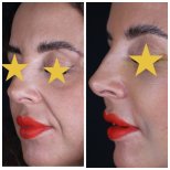 نتائج شد الوجه قبل وبعد في Esthétique du Nord، تأثير تجديد واضح للوجه