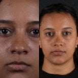 Resultados de rinoplastia antes y después, remodelación nasal y armonía facial