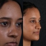 Resultados de rinoplastia antes y después, remodelación nasal para armonía facial