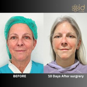 Before and after deep plane facelift results at ID Clinic Bangkok, visible facial rejuvenation