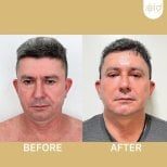 Before and after facelift results at ID Clinic Bangkok, visible facial rejuvenation in male patient