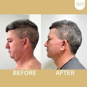 Facelift before and after results at ID Clinic Bangkok, visible neck and jawline improvement