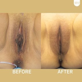 Before and after Genital PRP results at ID Clinic Bangkok, improved vaginal appearance