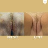 Before and after genital PRP treatment results at ID Clinic Bangkok, improved skin appearance