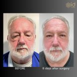 Before and after blepharoplasty results at ID Clinic Bangkok, visible eyelid improvement