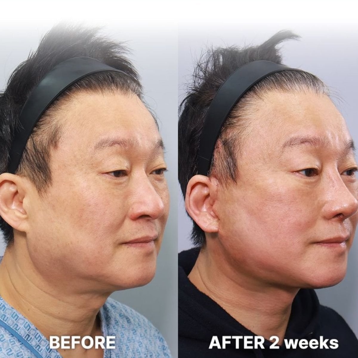 Resultados de lifting endoscópico facial en Returning Plastic Surgery, elevación visible