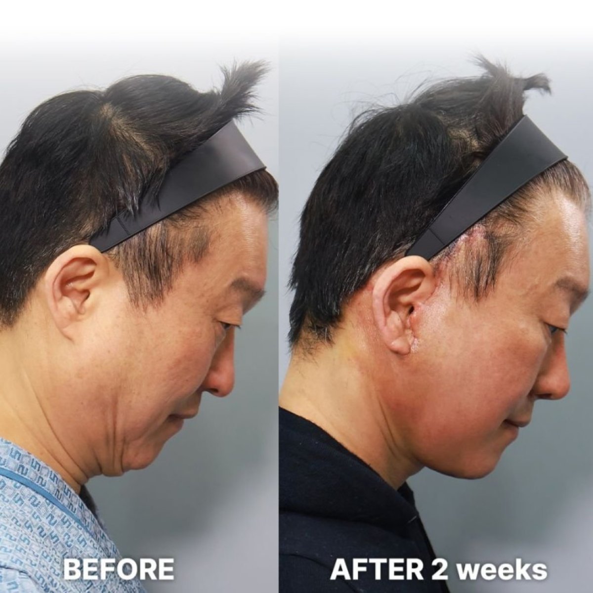 Resultado de lifting endoscópico facial en Returning Plastic Surgery, mejora visible del cuello