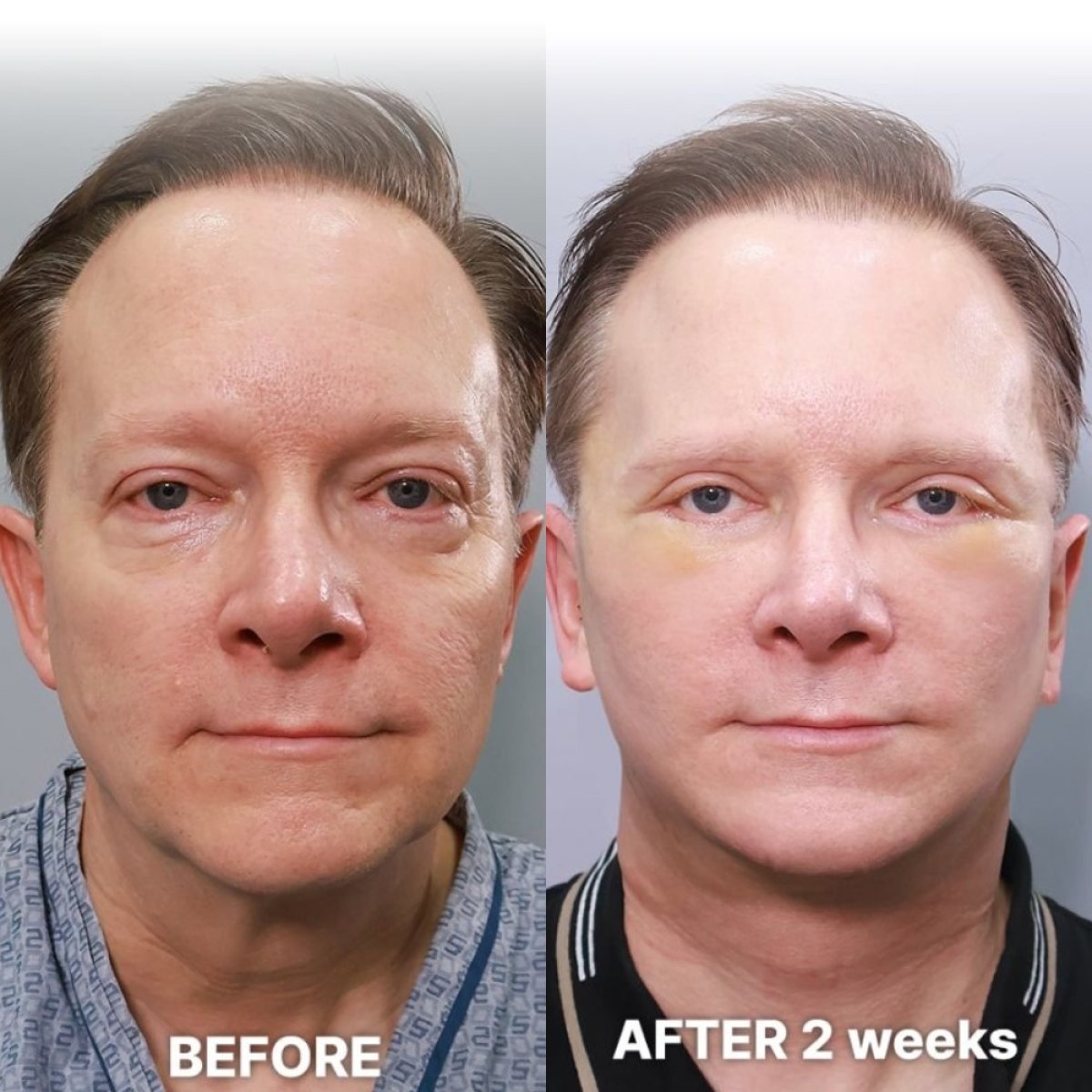 Resultados de lifting endoscópico facial antes y después en Returning Plastic Surgery, rejuvenecimiento visible