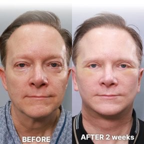 Эндоскопическая подтяжка лица до и после в Returning Plastic Surgery, видимое омоложение