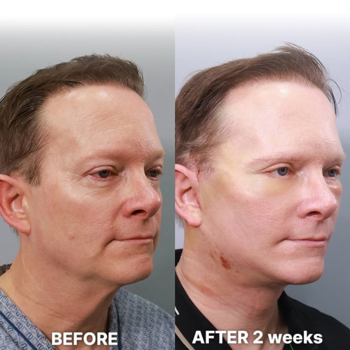 Resultados de lifting facial endoscópico antes y después en Returning Plastic Surgery, elevación visible