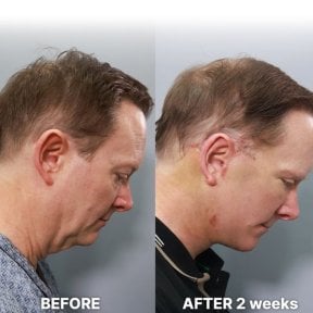 Результаты эндоскопической подтяжки лица в Returning Plastic Surgery, видимый лифтинг шеи
