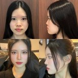 Before and after Asian rhinoplasty results at VG Plastic Surgery, nose reshaping improvement