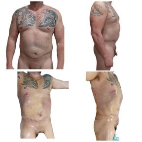 360 liposuction before and after results at Hospital de la Familia, visible body contouring