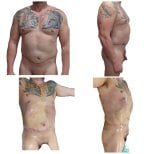 360 liposuction before and after results at Hospital de la Familia, visible body contouring