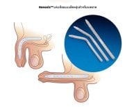 Penisimplantat-Ergebnis bei Menness Wellness Clinic – Genesis-Prothese Abbildung