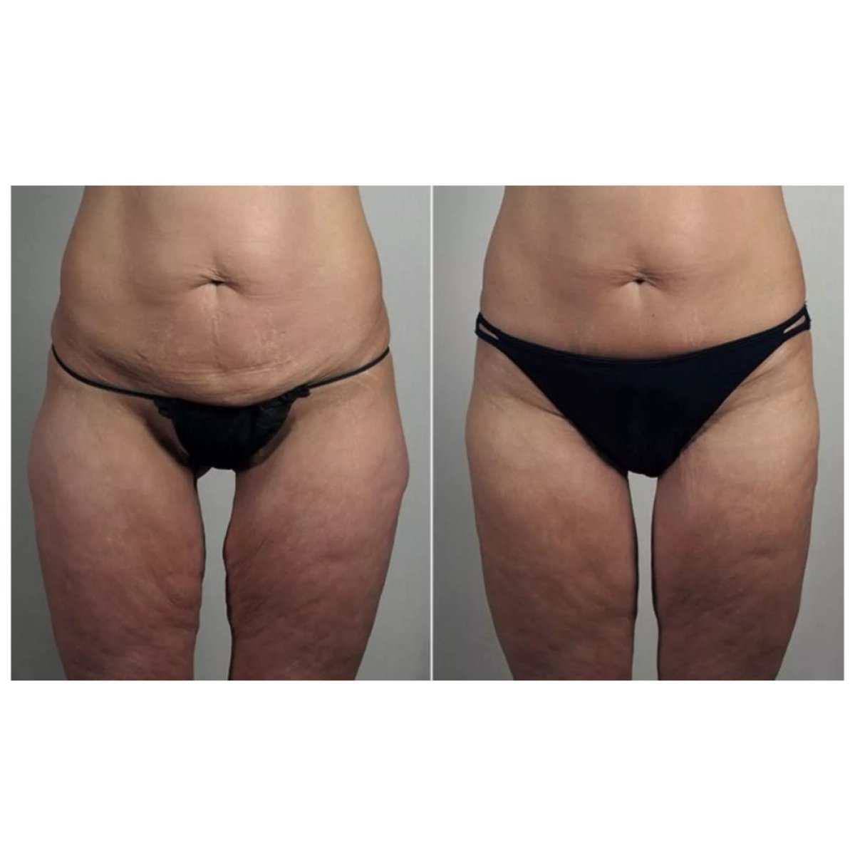 نتائج شد الفخذين قبل وبعد في Dr. Alexandro Aguilera - Plastic Surgery، تحسين الشكل