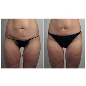 Before and after thigh lift results at Dr. Alexandro Aguilera - Plastic Surgery, improved contour