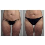 Before and after thigh lift results at Dr. Alexandro Aguilera - Plastic Surgery, improved contour