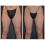 Before and after thigh lift results at Dr. Alexandro Aguilera - Plastic Surgery, smoother thighs