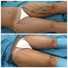 Before and after thigh lift results at Dr. Alexandro Aguilera - Plastic Surgery, improved contour