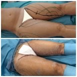 Before and after thigh lift results at Dr. Alexandro Aguilera - Plastic Surgery, improved contour