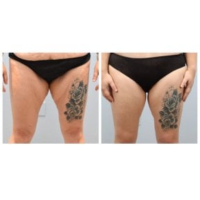 Before and after thigh lift results at Dr. Alexandro Aguilera - Plastic Surgery, improved contour