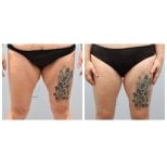 Before and after thigh lift results at Dr. Alexandro Aguilera - Plastic Surgery, improved contour