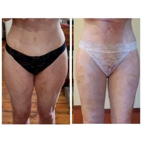 Before and after thigh lift results at Dr. Alexandro Aguilera - Plastic Surgery, slimmer thighs