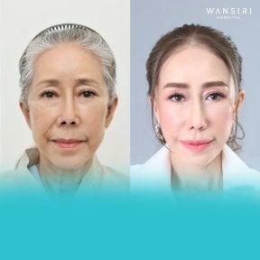 Before and after lip lift results at Wansiri Hospital, visible lip enhancement and youthful look