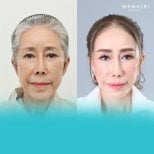 Before and after lip lift results at Wansiri Hospital, visible lip enhancement and youthful look