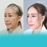 Before and after lip lift at Wansiri Hospital, visible lip enhancement and youthful result