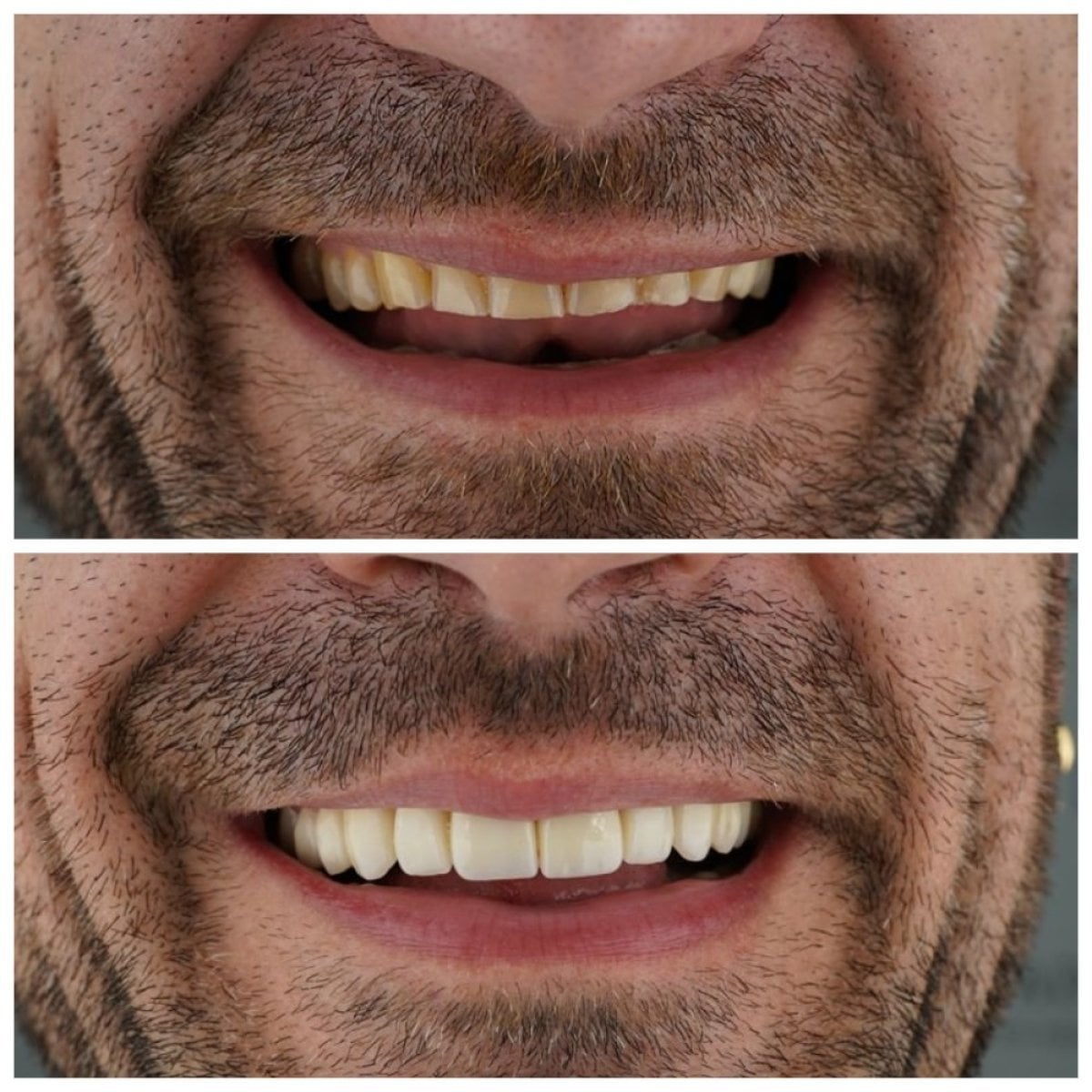 نتائج قبل وبعد تجميل الابتسامة في Nifa Dent International – مظهر أسنان محسن