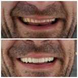 Smile makeover before and after results at Nifa Dent International – improved teeth appearance