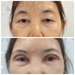 Before and after upper eyelid surgery results at PMG Hospital – rejuvenated eye appearance