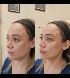 Résultat avant/après injection de fillers chez Dr. Lavalle, volume facial amélioré