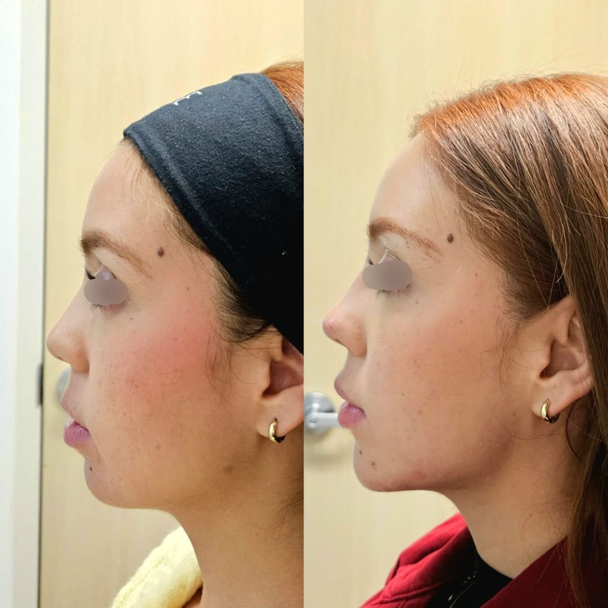 Before and after fillers injection result at Dr. Lavalle's Private Practice, enhanced chin contour