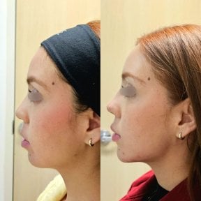 Résultat avant/après injection de fillers chez Dr. Lavalle's Private Practice, contour du menton amélioré
