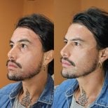 Résultat avant et après injection de fillers chez Dr. Lavalle's Private Practice, contour du visage amélioré