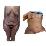 Before and after post-bariatric plastic surgery results at Hospital de la Familia, body contouring